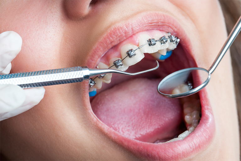 "Orthodontic treatment for teeth alignment at Krishna Dental Hospitals, Hyderabad"