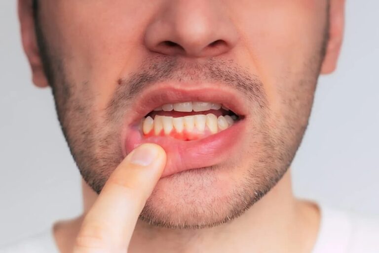 Smoking vs. Vaping: What Both Really Do to Your Teeth & Gums