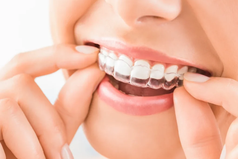 Invisalign Aligners
