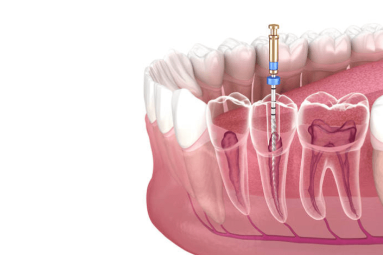 Root Canal