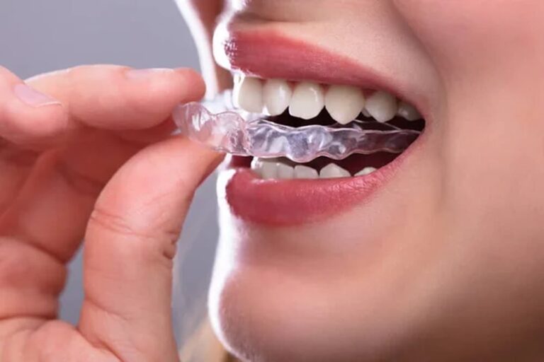 What Are Aligners? Everything You Need to Know Before Starting Treatment