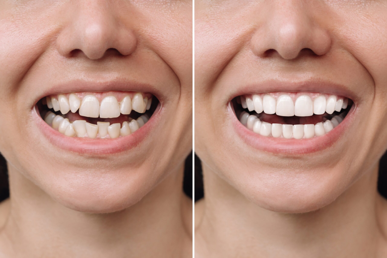 What Are Dental Veneers? The Complete Guide to a Confident, Natural Smile