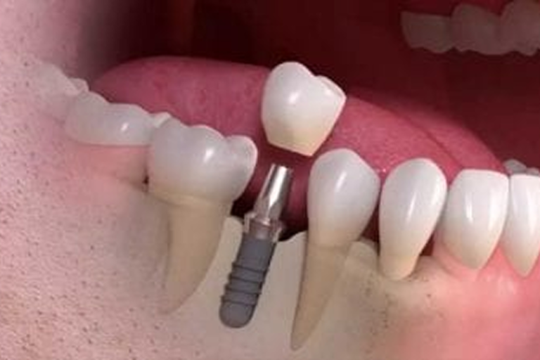 How Safe Are Dental Implants?