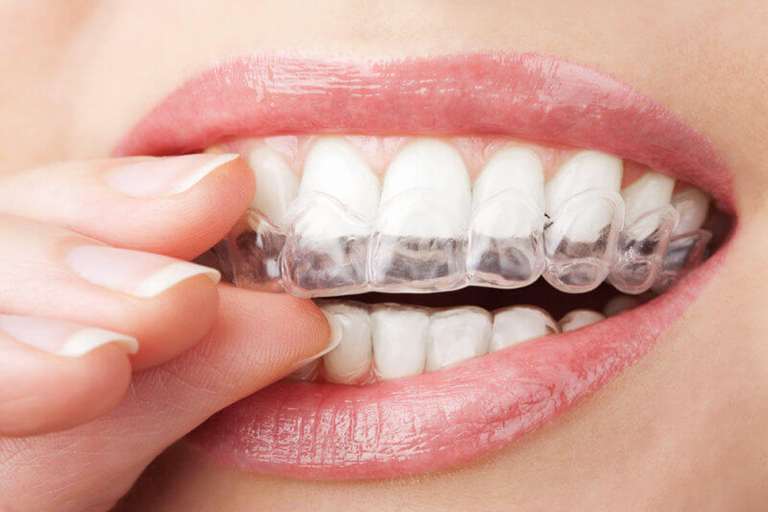 Invisalign Cost in Hyderabad 2026