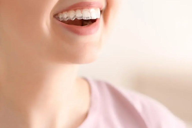Benefits of Invisalign