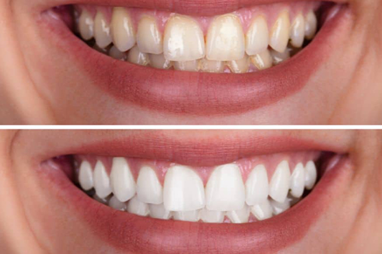 Teeth Cleaning vs Teeth Whitening: Which One Does Your Smile Actually Need?