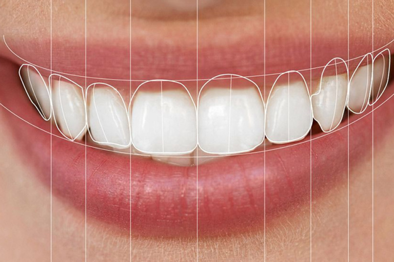 What Is Digital Smile Design? The Complete Guide to How It Works and What It Costs