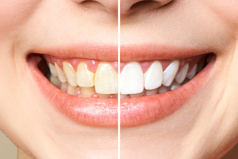 Teeth Whitening Cost in Hyderabad: 2026 Price Guide 